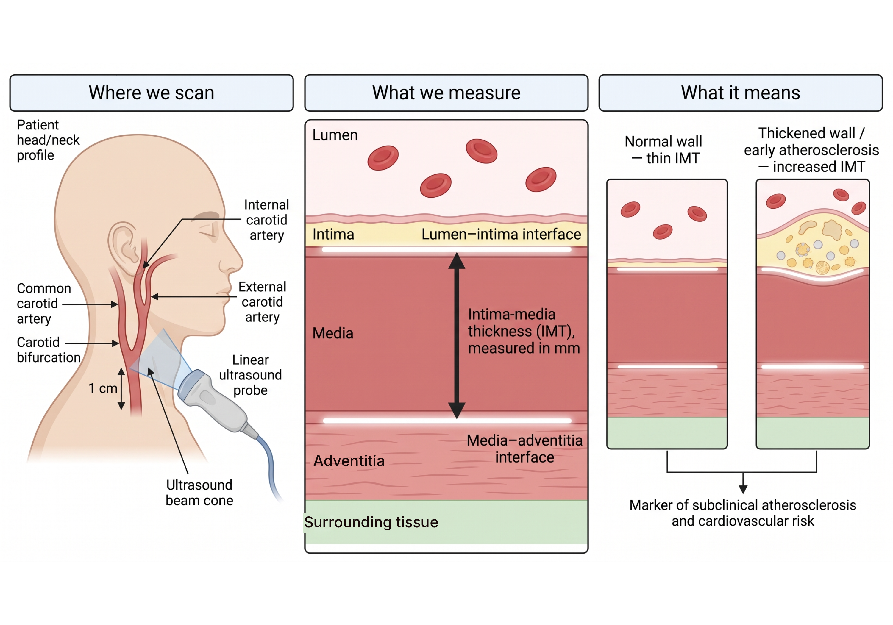 Scientific figure explaining carotid intima-media thickness (CIMT): where the neck is scanned with a linear ultrasound probe; wall layers from the lumen outward labeled intima, media, and adventitia, with the IMT span from the lumen-intima edge to the media-adventitia edge and adventitia excluded; the band outside the wall is labeled surrounding tissue; and what thickened IMT means for subclinical atherosclerosis risk.